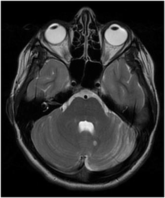 Update in Autoimmune Movement Disorders: Newly Described Antigen Targets in Autoimmune and Paraneoplastic Cerebellar Ataxia